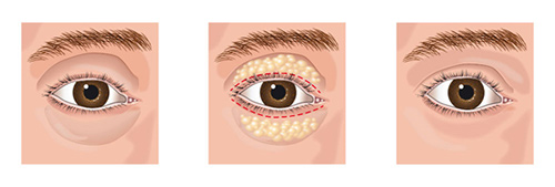 Chart Showing the Blepharoplasty Process