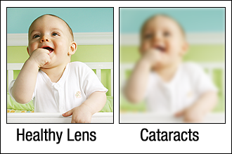 Chart Showing What It's Like to See With a Healthy Lens Compared to One With Cataracts